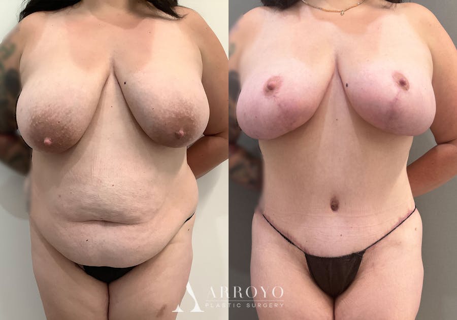 Tummy Tuck Before & After Gallery - Patient 177437 - Image 1