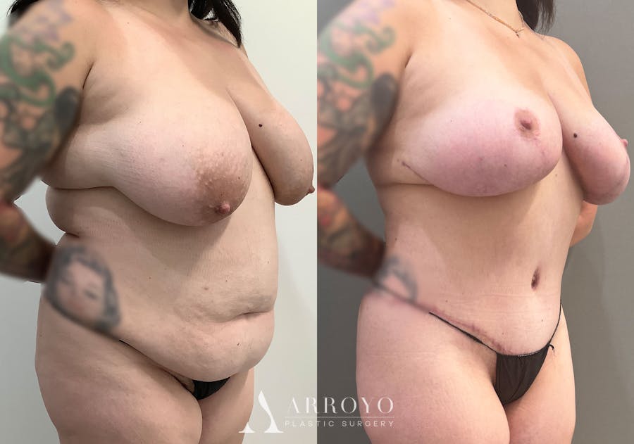 Tummy Tuck Before & After Gallery - Patient 177437 - Image 2