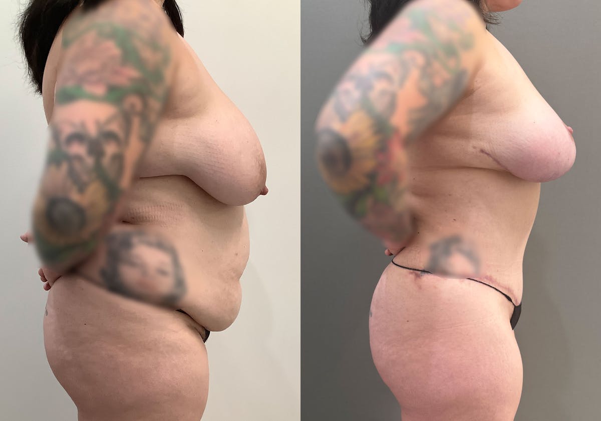 Tummy Tuck Before & After Gallery - Patient 177437 - Image 3