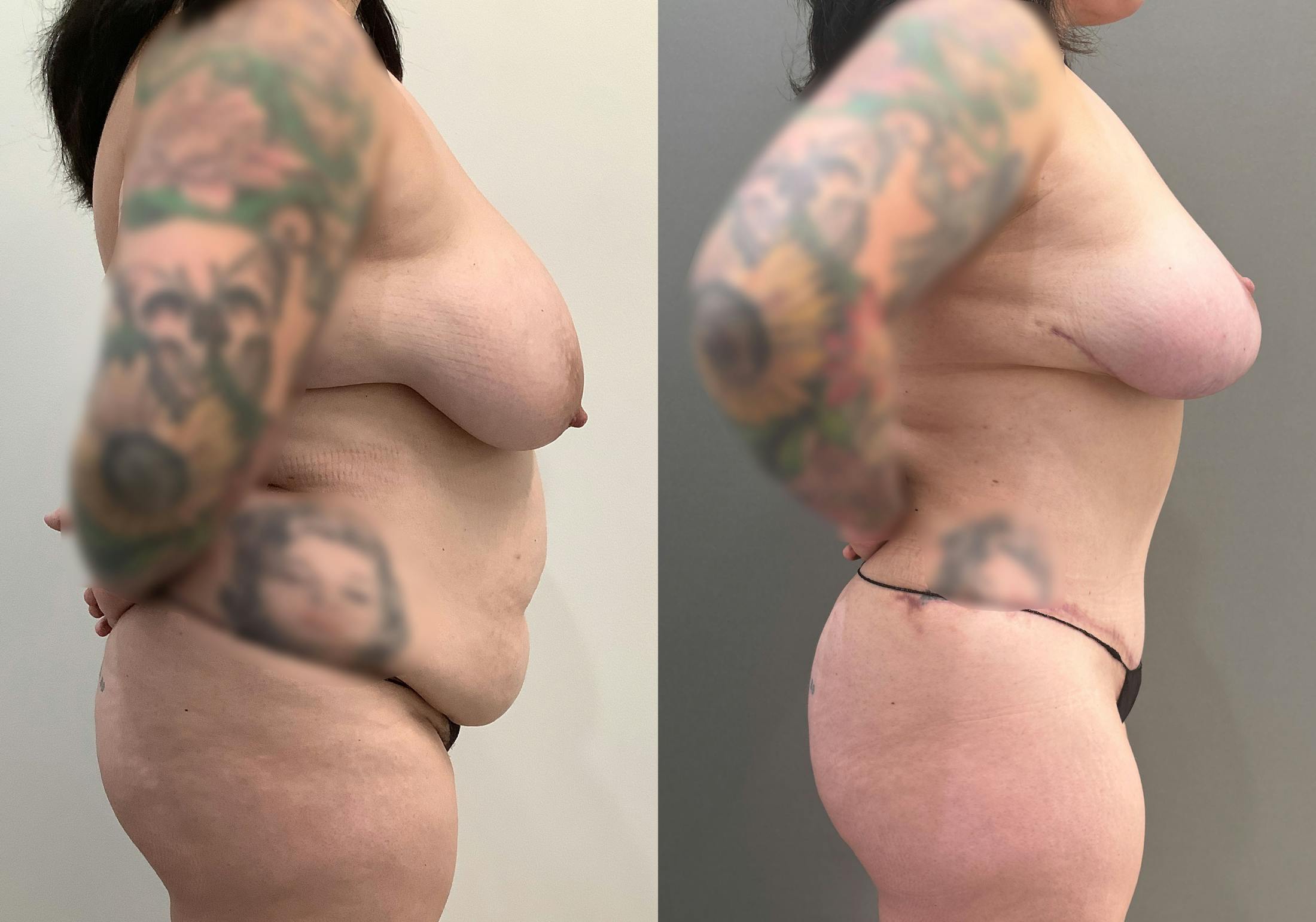 Liposuction Before & After Gallery - Patient 364721 - Image 3