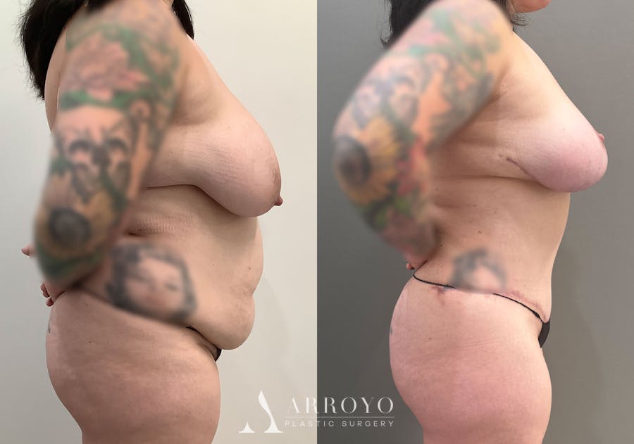 Tummy Tuck Before & After Gallery - Patient 177437 - Image 3