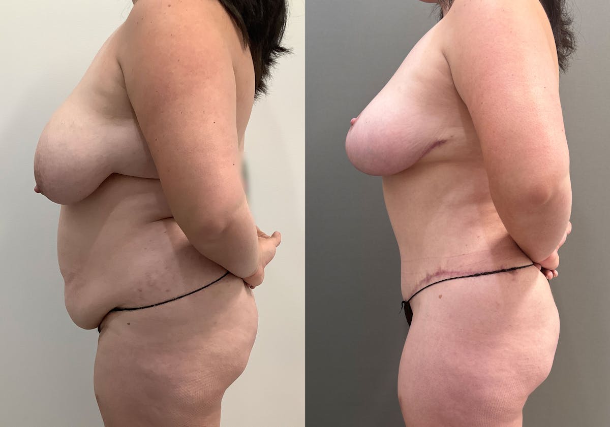 Tummy Tuck Before & After Gallery - Patient 177437 - Image 5