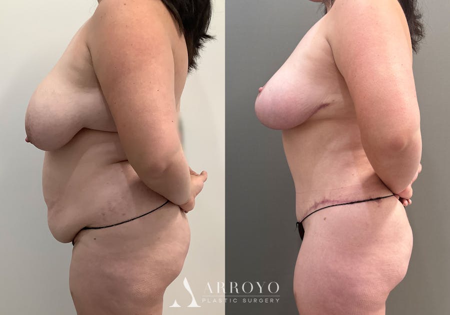 Tummy Tuck Before & After Gallery - Patient 177437 - Image 5