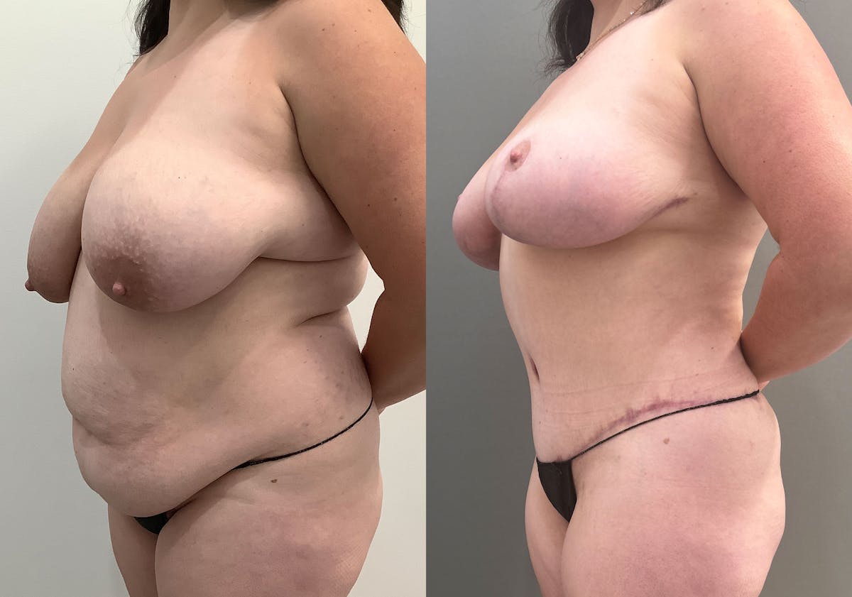 Tummy Tuck Before & After Gallery - Patient 177437 - Image 6