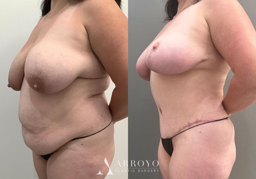 Tummy Tuck Before & After Gallery - Patient 177437 - Image 6