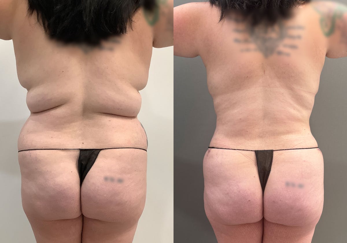 Tummy Tuck Before & After Gallery - Patient 177437 - Image 4