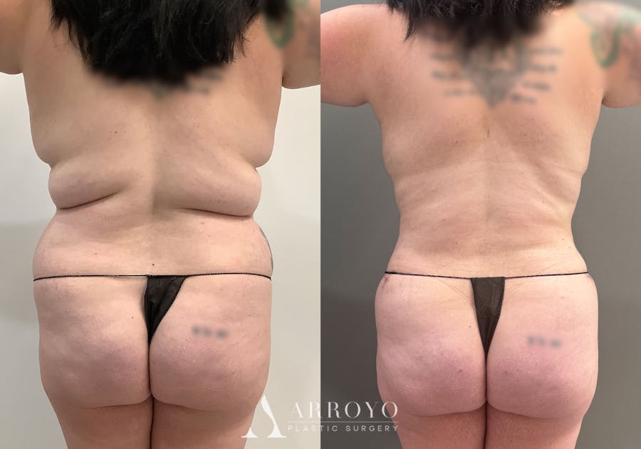 Tummy Tuck Before & After Gallery - Patient 177437 - Image 4
