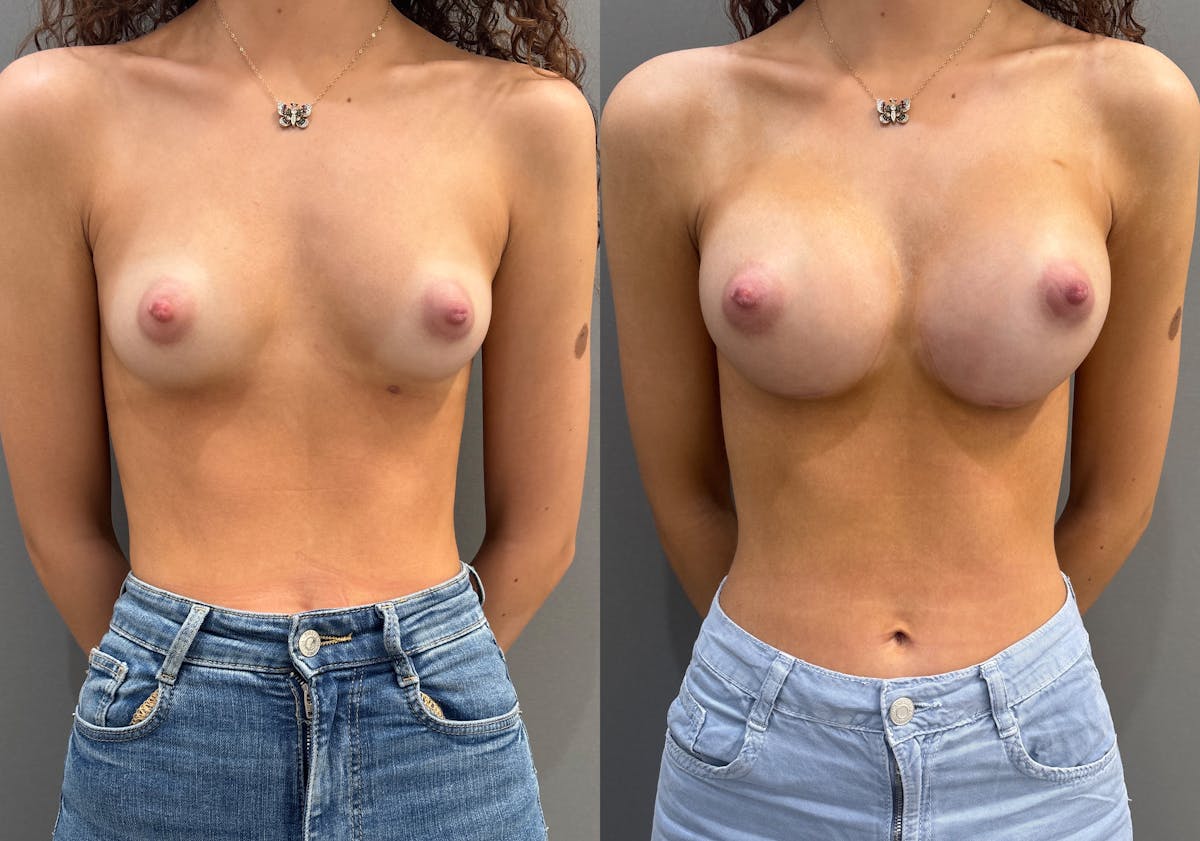 Breast Augmentation Before & After Gallery - Patient 210583 - Image 1