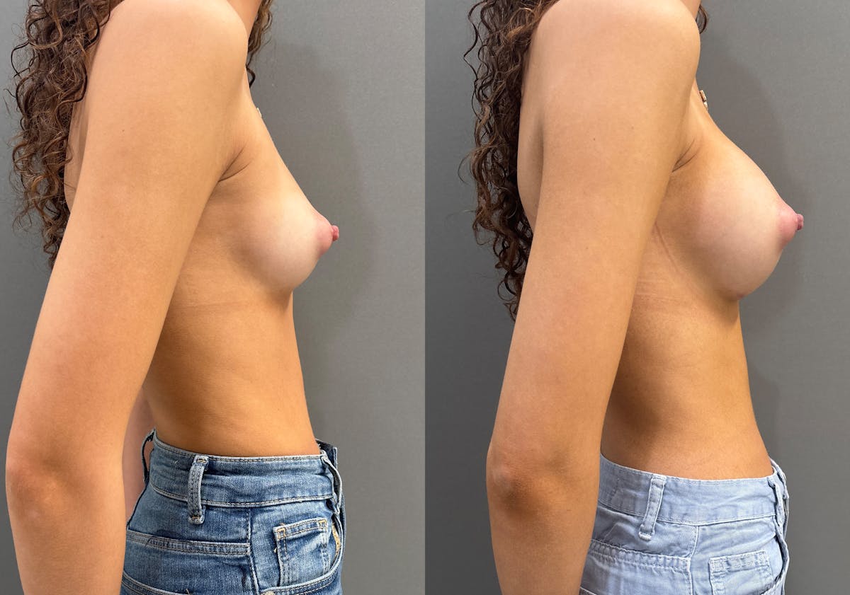 Breast Augmentation Before & After Gallery - Patient 210583 - Image 3