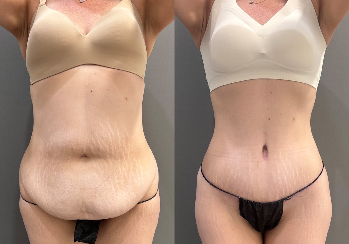 Tummy Tuck Before & After Gallery - Patient 351711 - Image 1