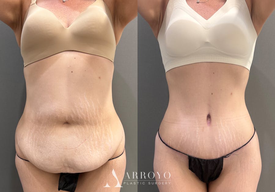 Tummy Tuck Before & After Gallery - Patient 351711 - Image 1
