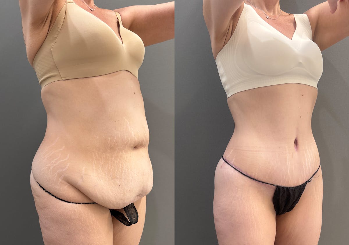 Tummy Tuck Before & After Gallery - Patient 351711 - Image 2