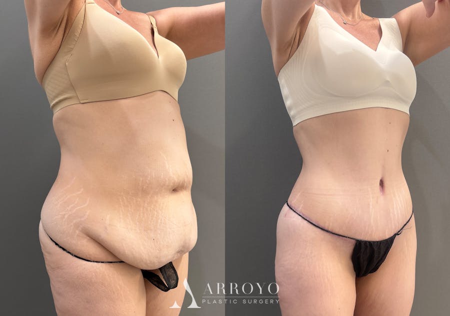 Tummy Tuck Before & After Gallery - Patient 351711 - Image 2