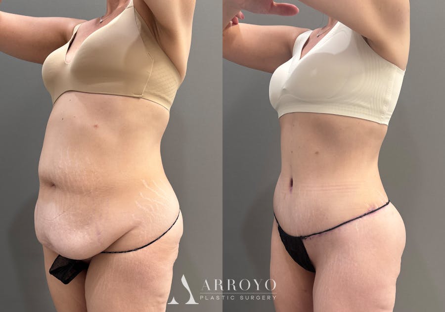 Tummy Tuck Before & After Gallery - Patient 351711 - Image 4