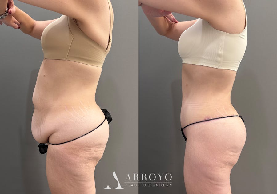 Tummy Tuck Before & After Gallery - Patient 351711 - Image 5