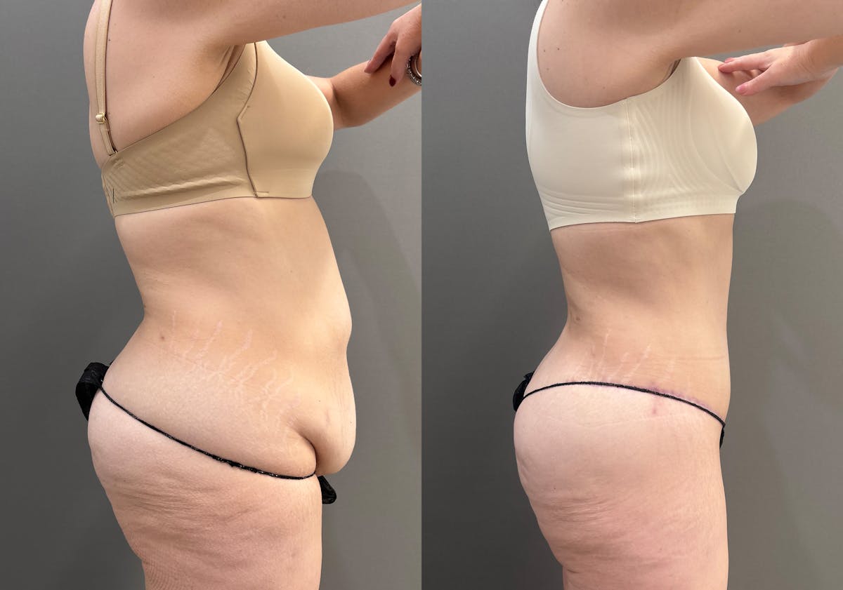 Tummy Tuck Before & After Gallery - Patient 351711 - Image 3
