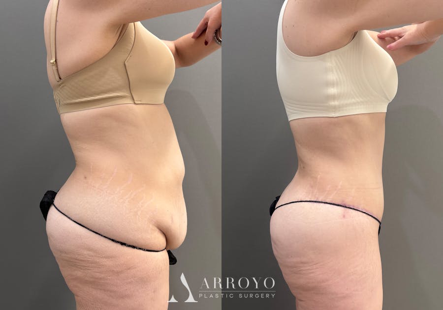 Tummy Tuck Before & After Gallery - Patient 351711 - Image 3