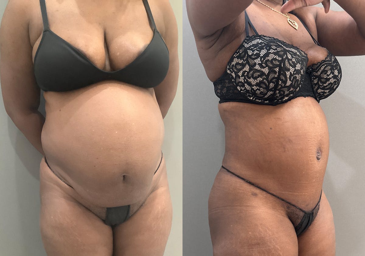 Tummy Tuck Before & After Gallery - Patient 332939 - Image 2