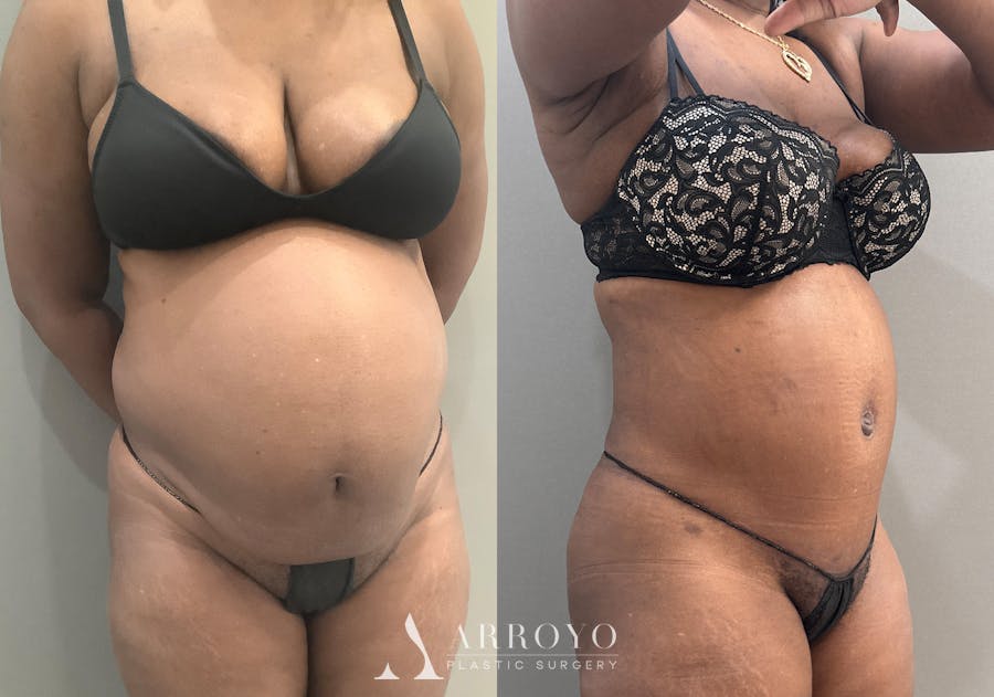 Tummy Tuck Before & After Gallery - Patient 332939 - Image 2