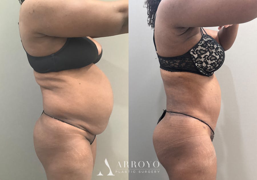Tummy Tuck Before & After Gallery - Patient 332939 - Image 3