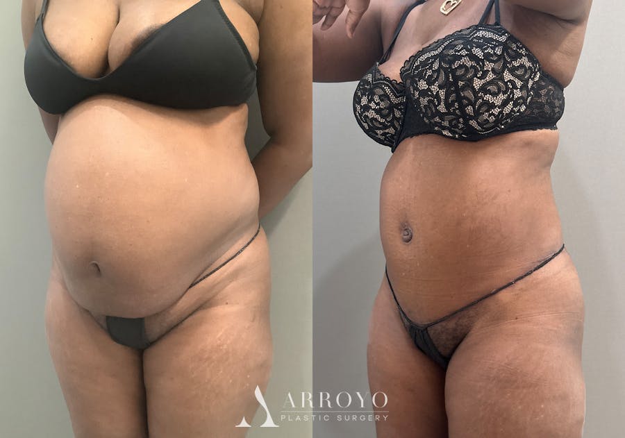 Tummy Tuck Before & After Gallery - Patient 332939 - Image 4