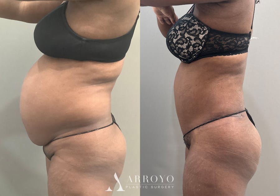 Tummy Tuck Before & After Gallery - Patient 332939 - Image 5