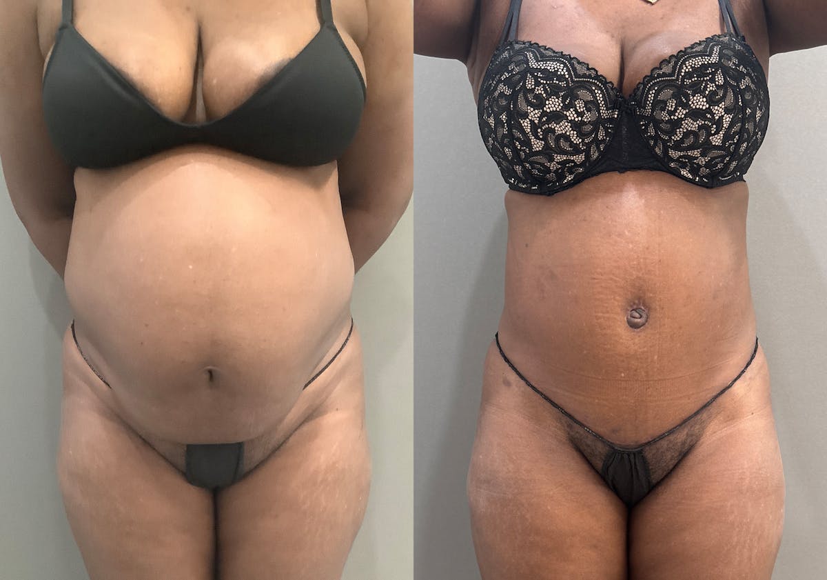 Tummy Tuck Before & After Gallery - Patient 332939 - Image 1