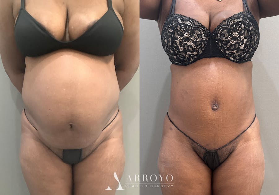 Tummy Tuck Before & After Gallery - Patient 332939 - Image 1