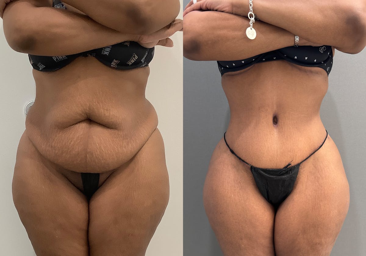 Liposuction Before & After Gallery - Patient 338212 - Image 1