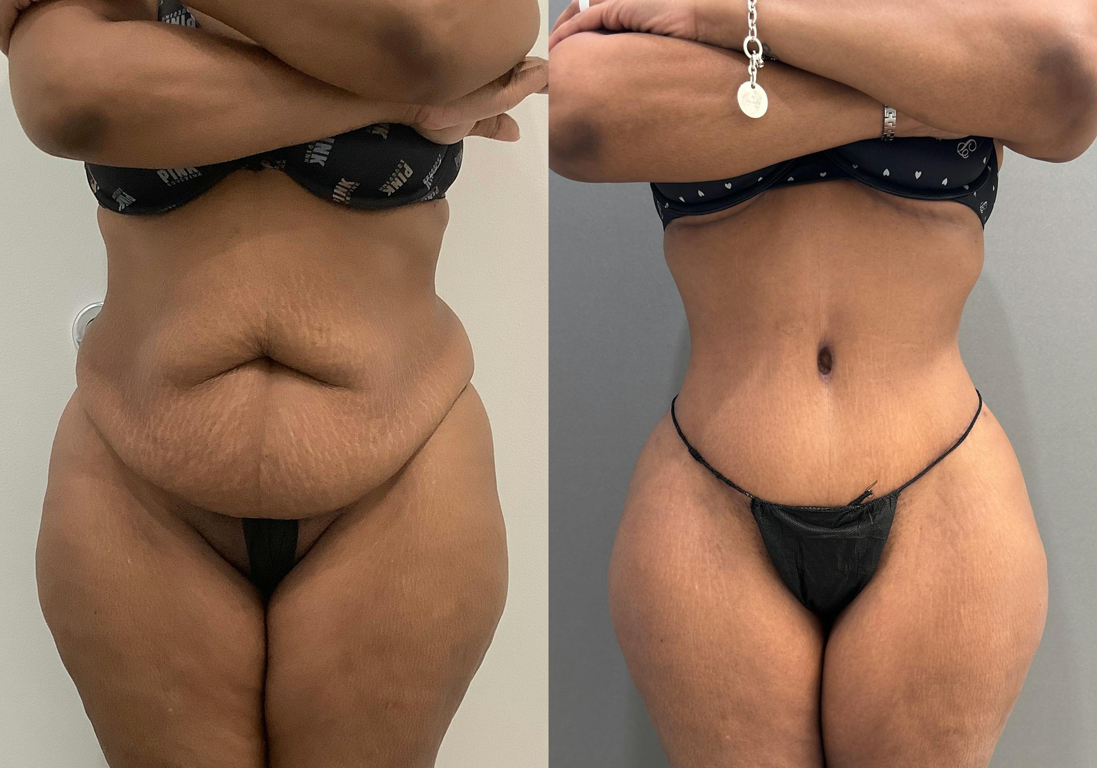 Tummy Tuck Before & After Gallery - Patient 364874 - Image 1