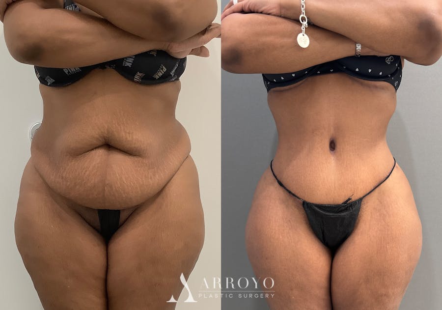 Tummy Tuck Before & After Gallery - Patient 364874 - Image 1