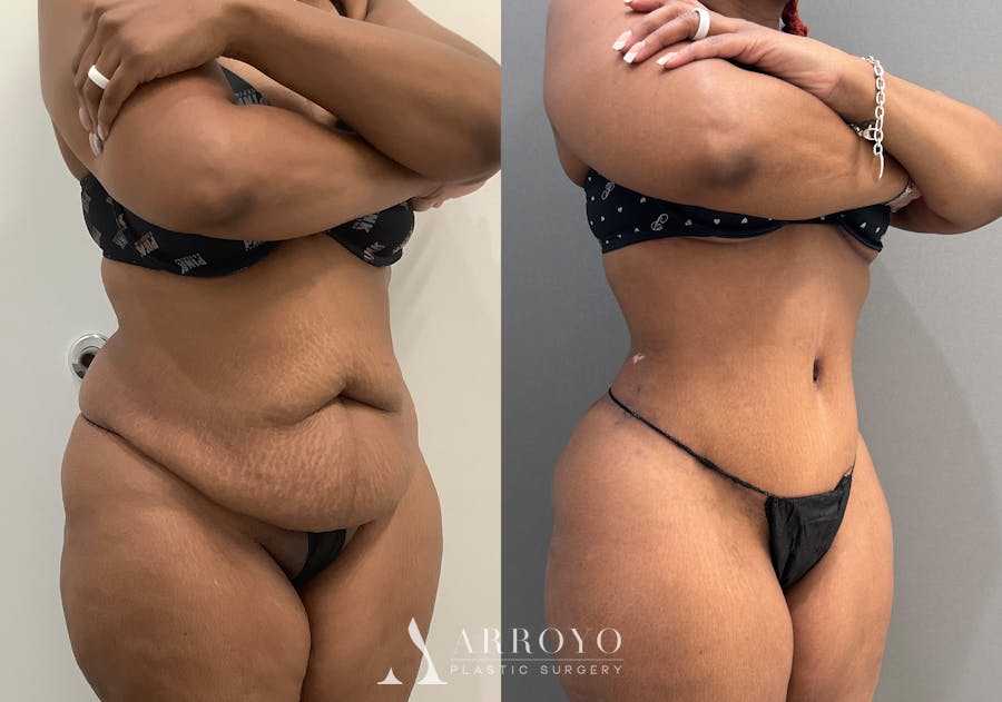 Tummy Tuck Before & After Gallery - Patient 364874 - Image 2