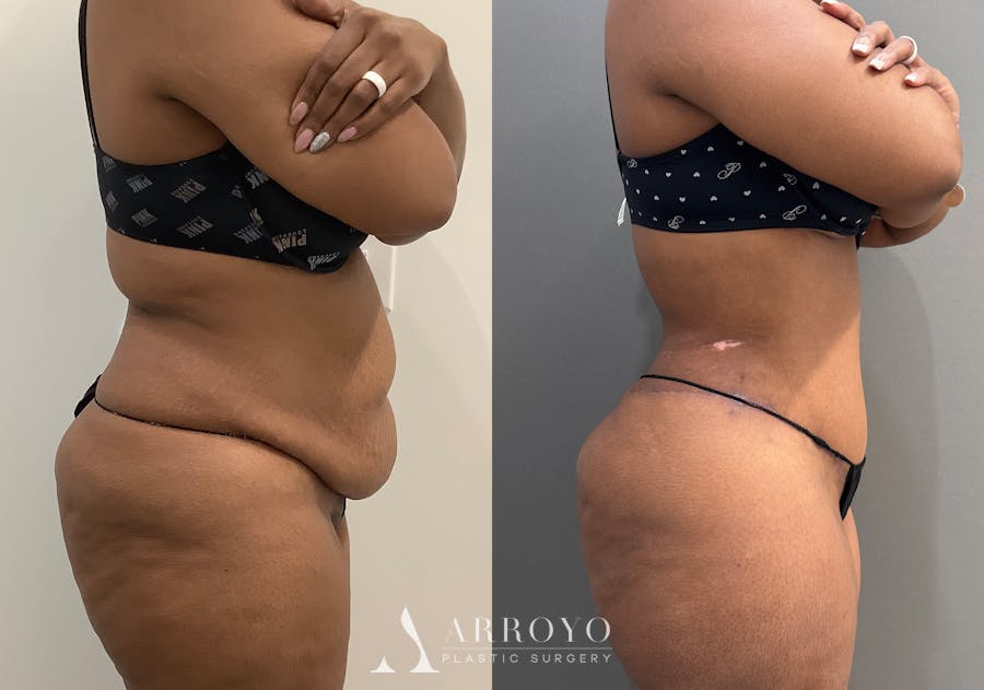 Tummy Tuck Before & After Gallery - Patient 364874 - Image 3