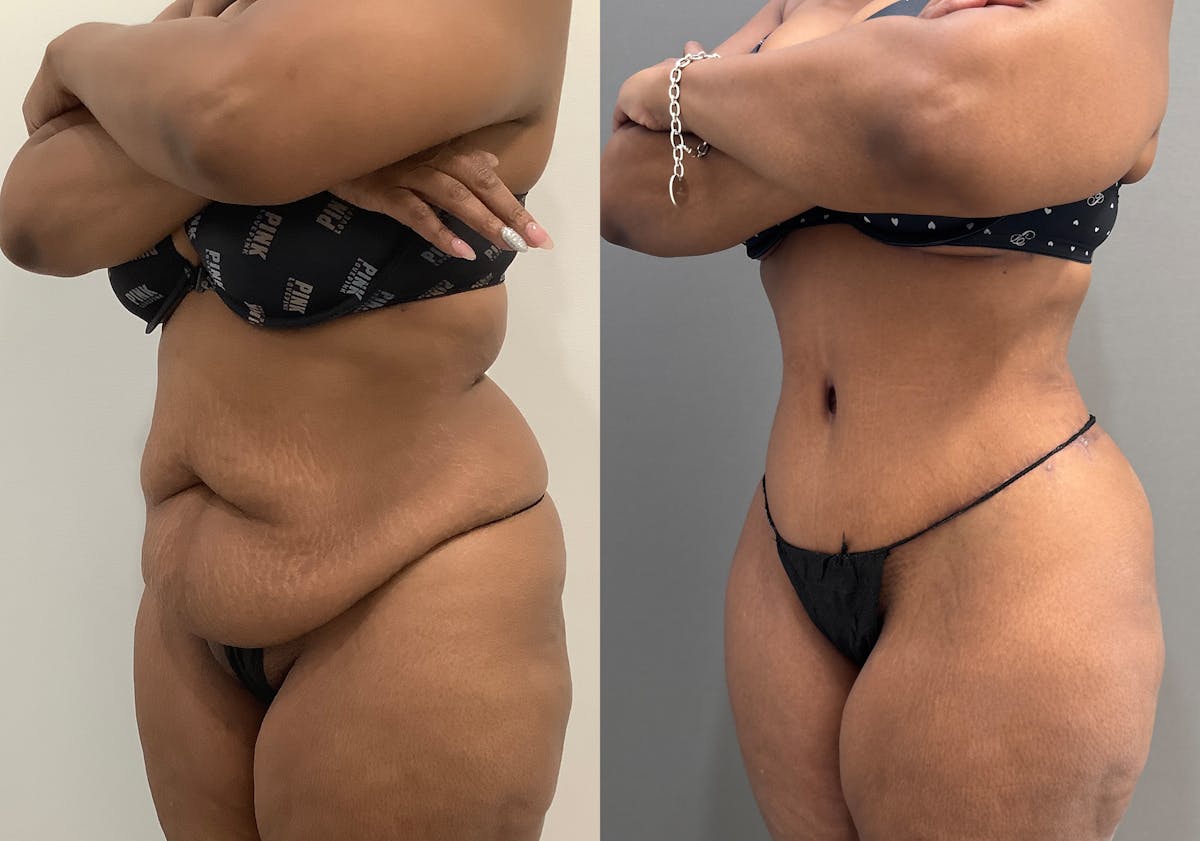 Liposuction Before & After Gallery - Patient 338212 - Image 4