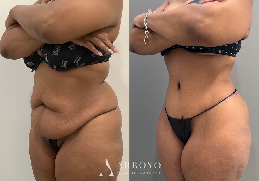 Tummy Tuck Before & After Gallery - Patient 364874 - Image 4