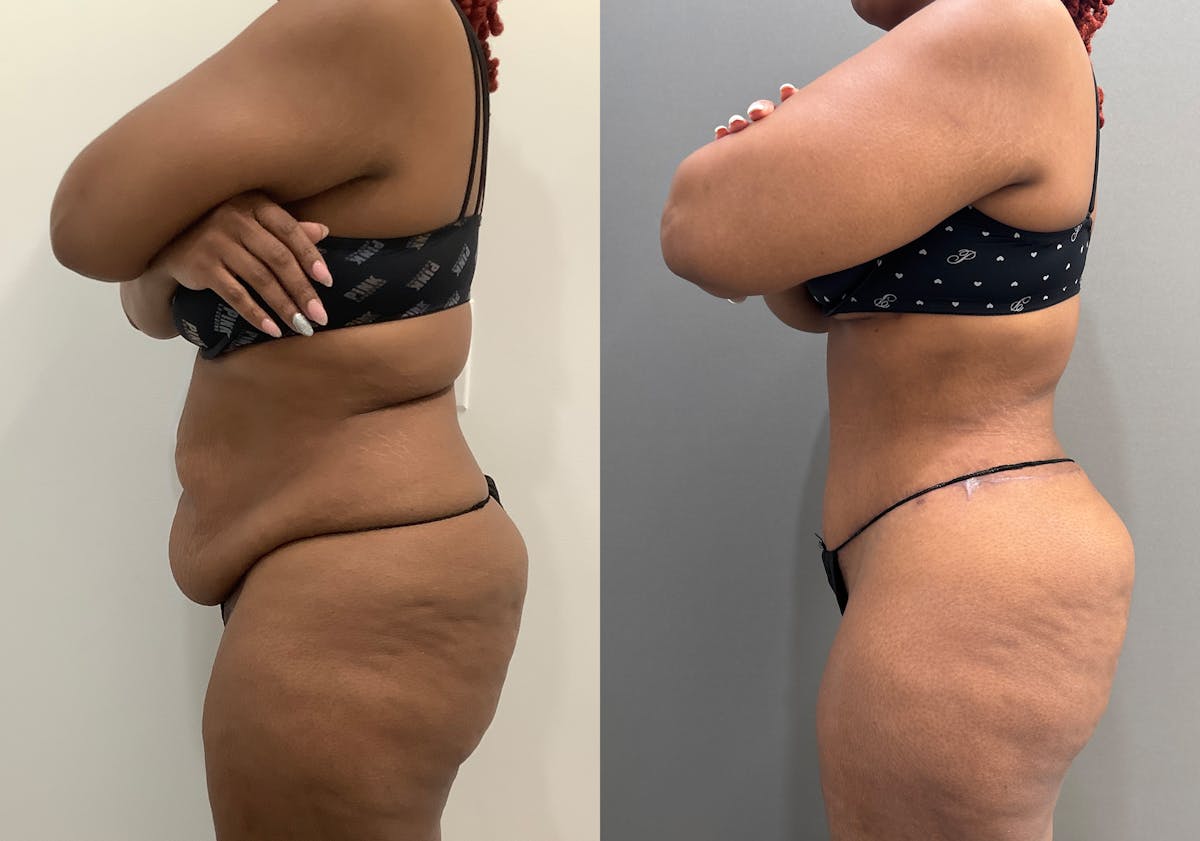 Liposuction Before & After Gallery - Patient 338212 - Image 5