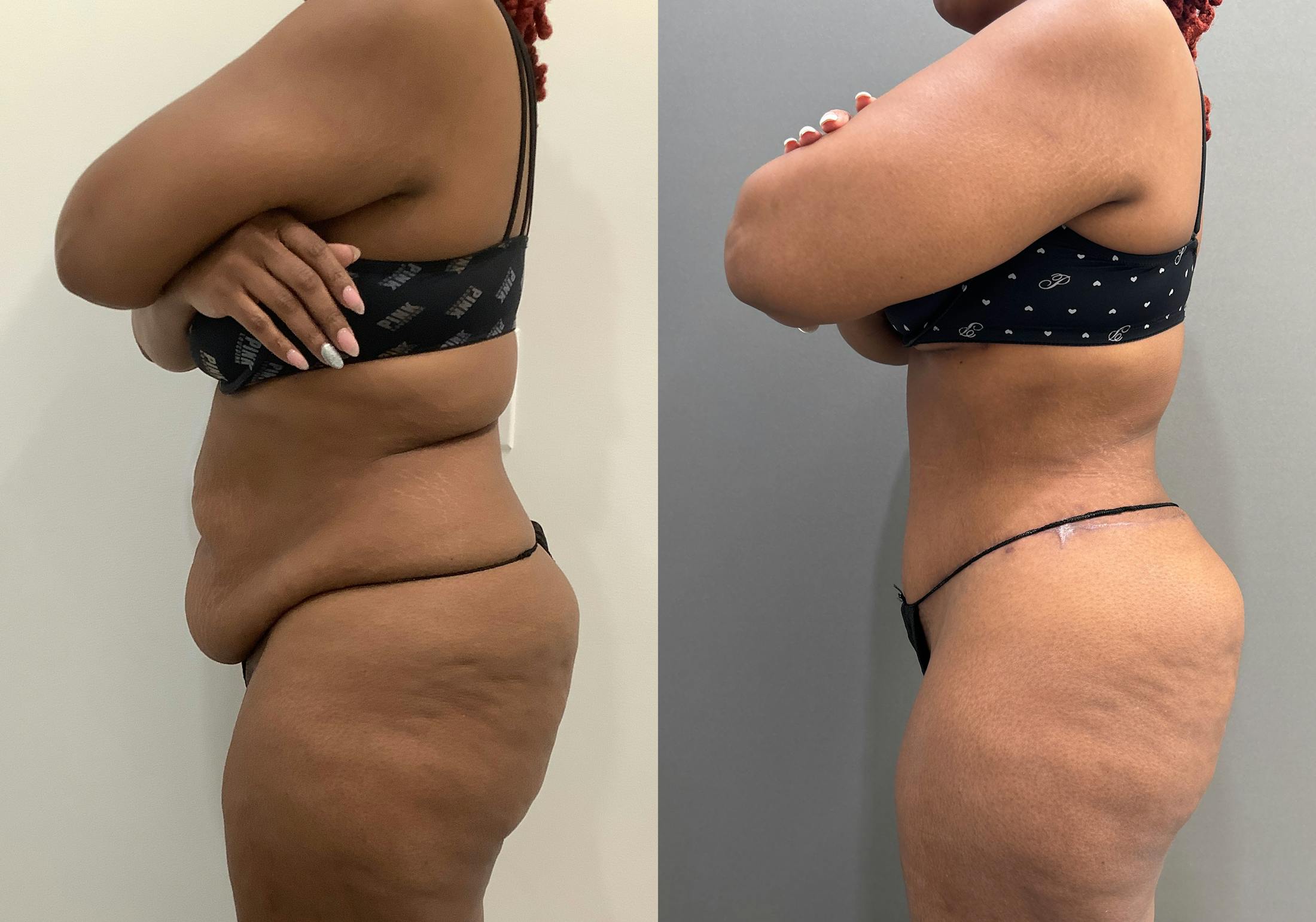 Tummy Tuck Before & After Gallery - Patient 364874 - Image 5