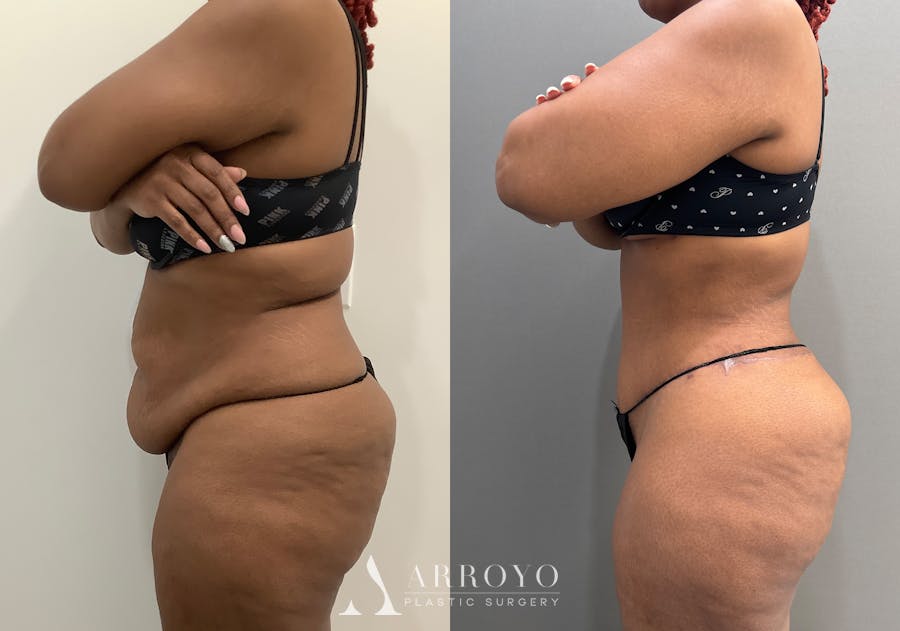 Tummy Tuck Before & After Gallery - Patient 364874 - Image 5