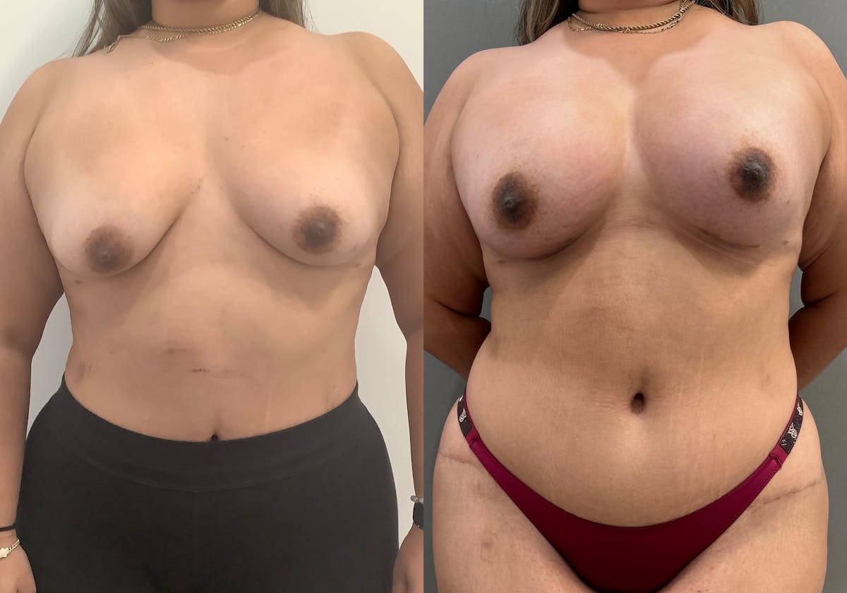 Breast Augmentation Before & After Gallery - Patient 231102 - Image 1