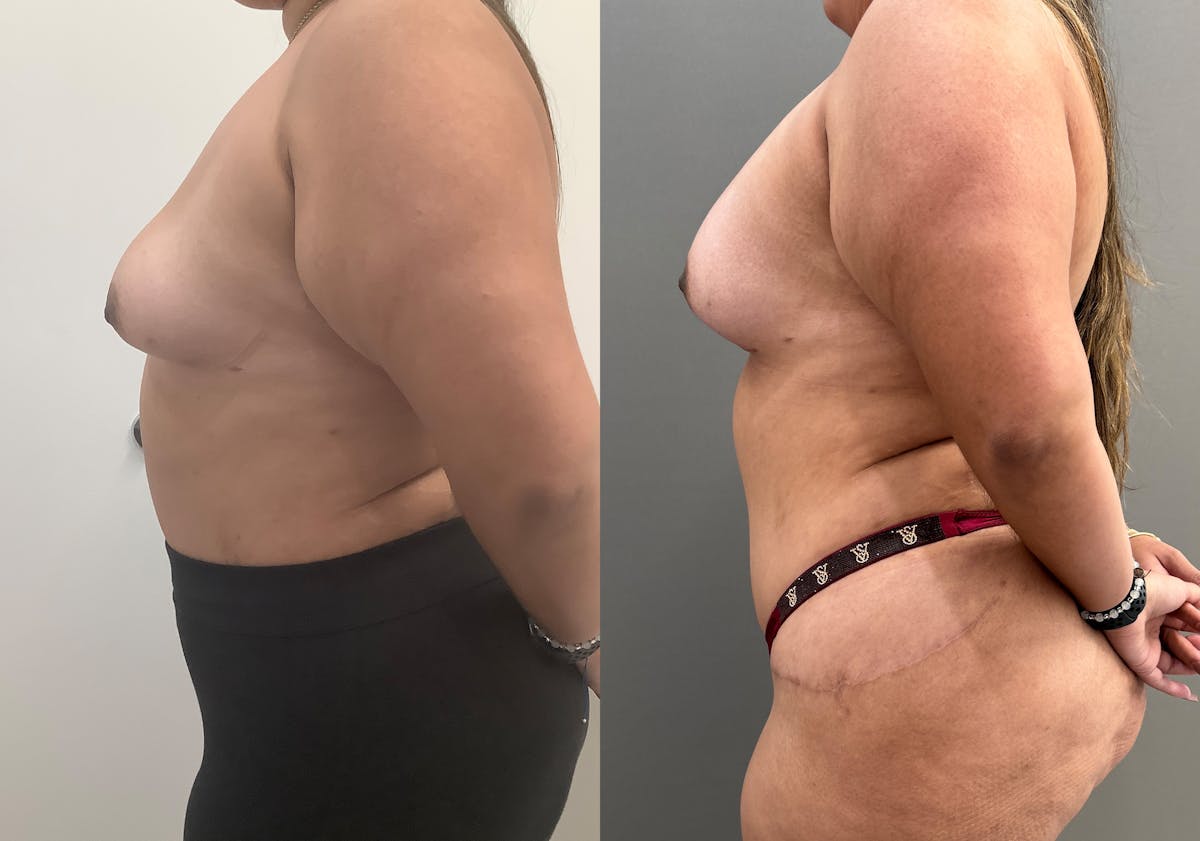 Breast Augmentation Before & After Gallery - Patient 231102 - Image 3