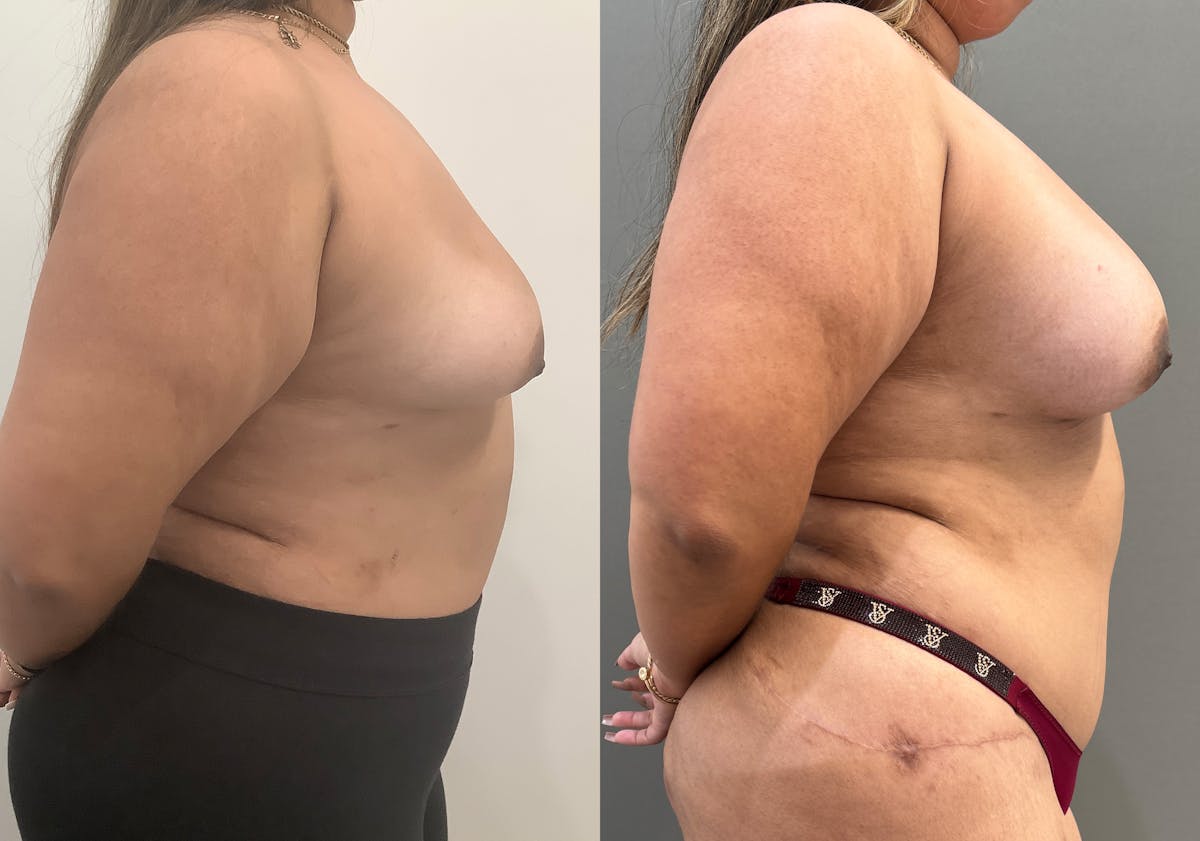 Breast Augmentation Before & After Gallery - Patient 231102 - Image 2