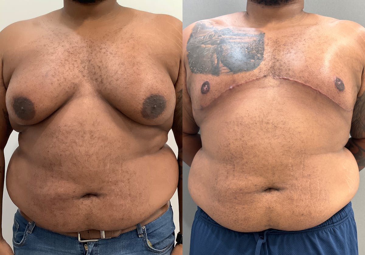 Gynecomastia Before & After Gallery - Patient 398473 - Image 1