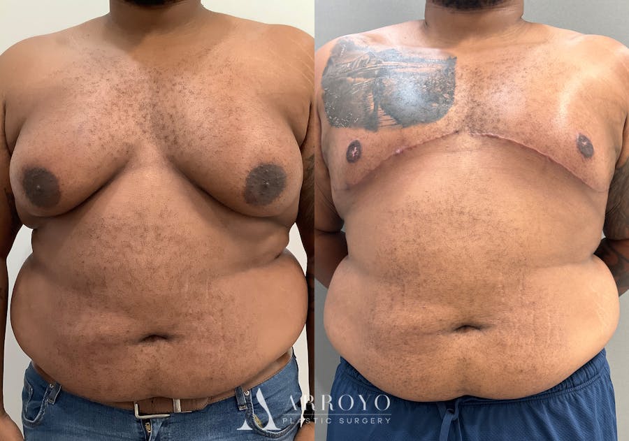 Gynecomastia Before & After Gallery - Patient 398473 - Image 1