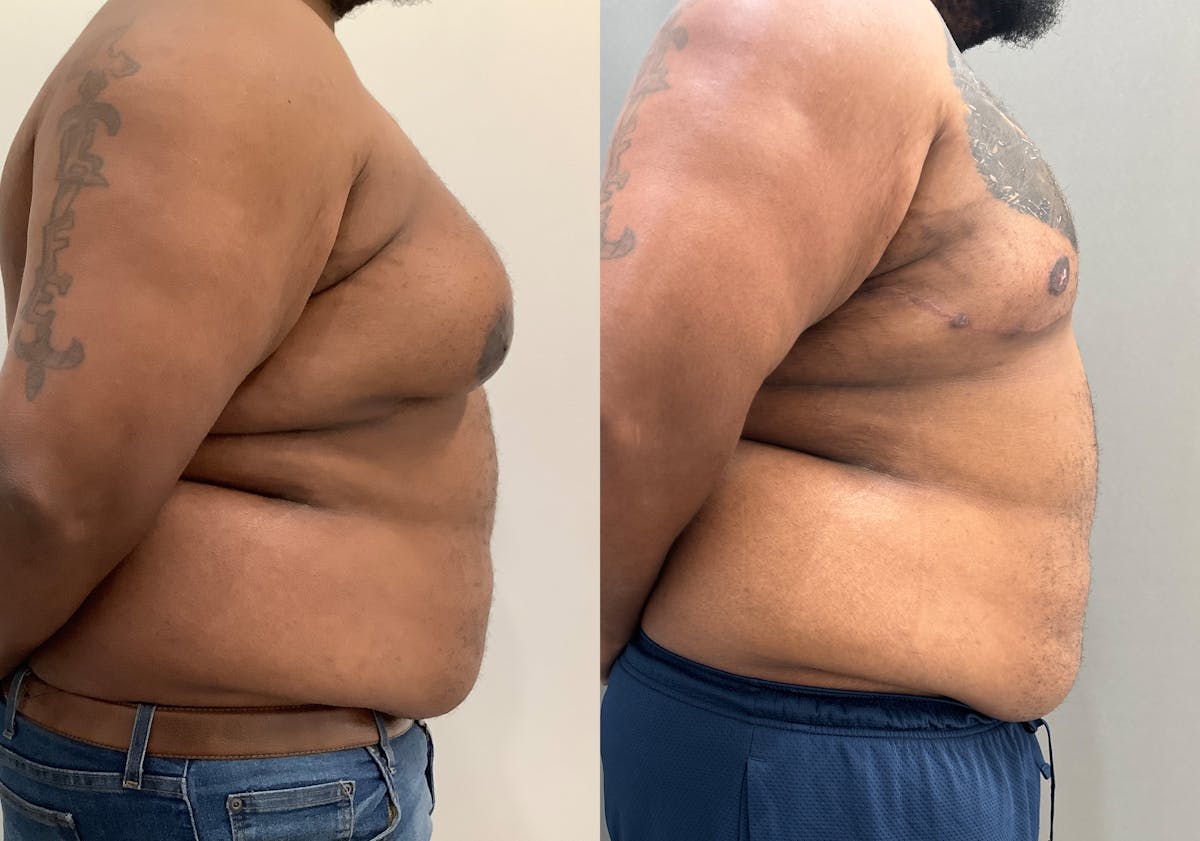 Gynecomastia Before & After Gallery - Patient 398473 - Image 2