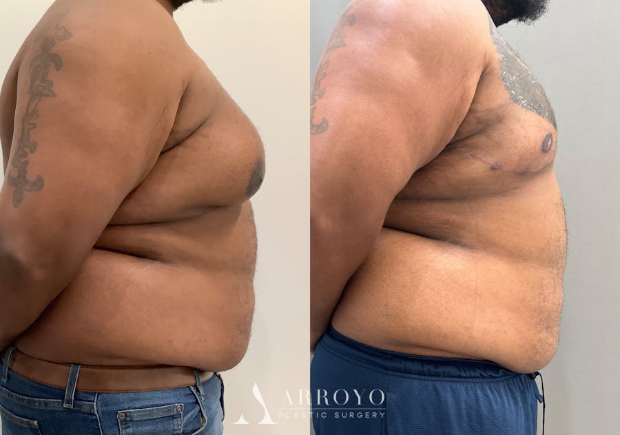 Gynecomastia Before & After Gallery - Patient 398473 - Image 2