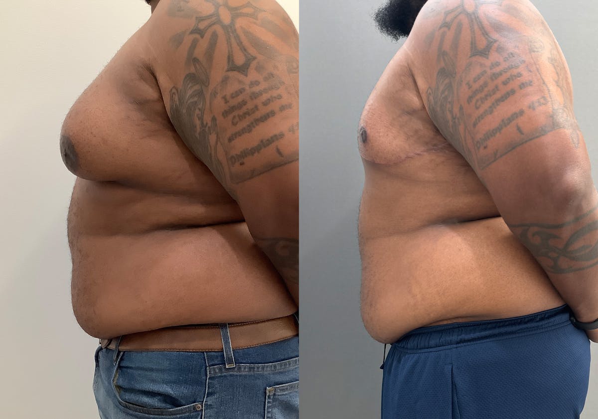 Gynecomastia Before & After Gallery - Patient 398473 - Image 3