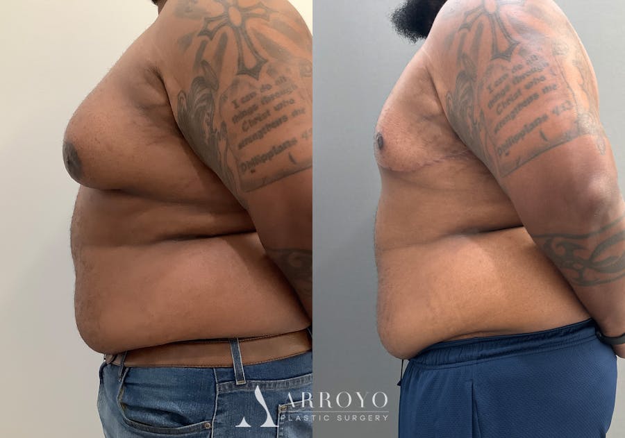 Gynecomastia Before & After Gallery - Patient 398473 - Image 3