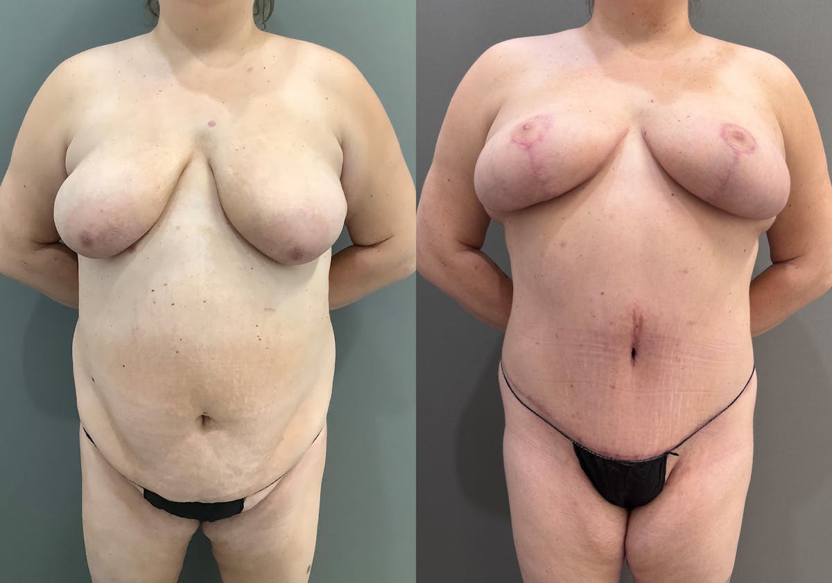 Tummy Tuck Before & After Gallery - Patient 185271 - Image 1