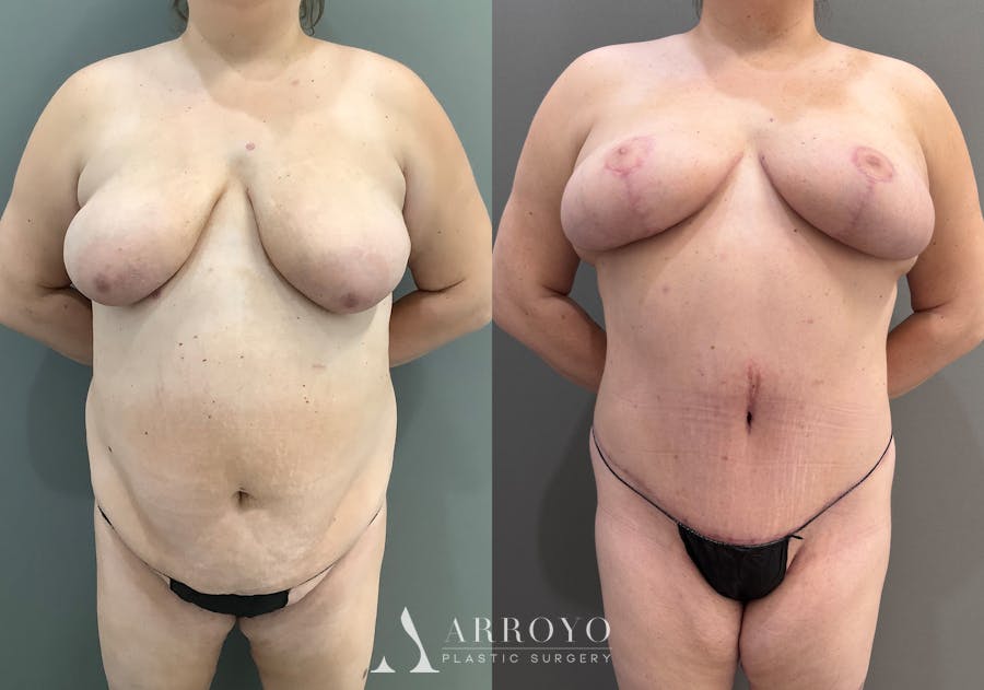 Tummy Tuck Before & After Gallery - Patient 185271 - Image 1