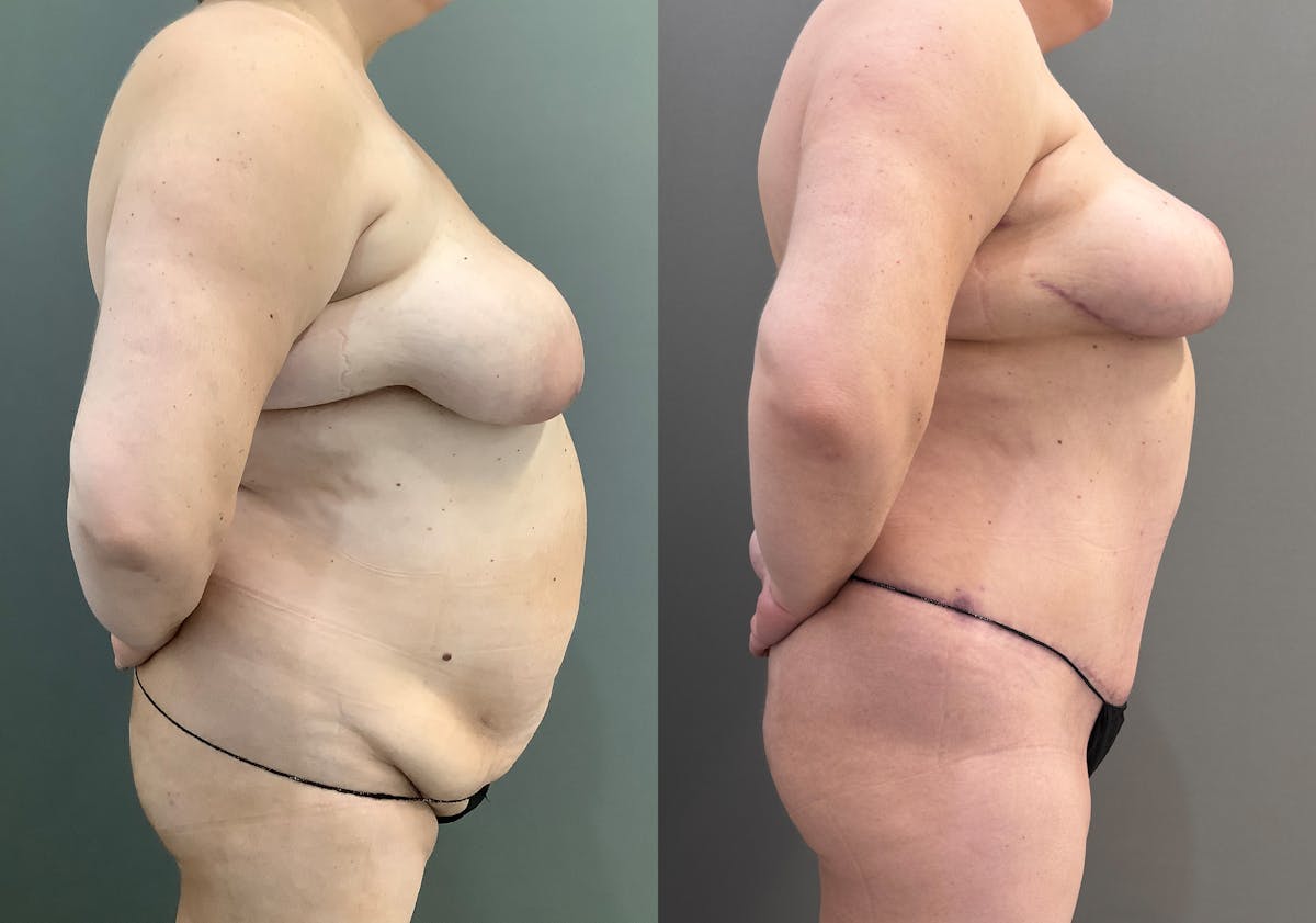 Tummy Tuck Before & After Gallery - Patient 185271 - Image 2